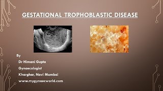 Gestational Trophoblastic Disease  Video SeriesEpi1 [upl. by Nnaitak387]