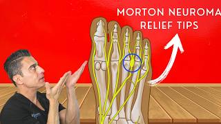 Relieve Morton’s Neuroma Pain Best Tips and Tricks [upl. by Balsam685]