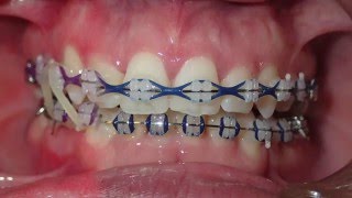 Orthodontic Transformation from Start to Finish [upl. by Akimaj575]