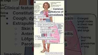 Common features of sarcoidosis [upl. by Anyahs]