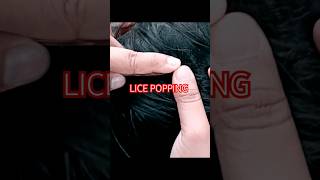 ASMR LICE POPPING lice hair liceremoval satisfying [upl. by Wardlaw]