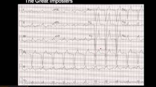 1215 Lead ECG MI Imposter 3 [upl. by Whallon]