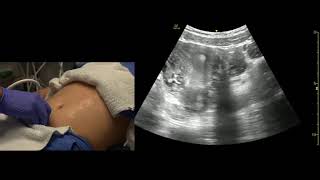 Transabdominal Pelvis Ultrasound Scanning Techniques [upl. by Levon3]