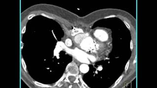 Cardiac Pseudoaneurysm of ascending aorta 2 of 5 [upl. by Etsirhc]