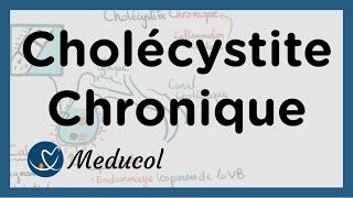 Cholécystite chronique calcul vésicule biliaire symptômes inflammation et cholécystectomie [upl. by Eeralav]