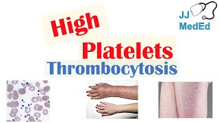 What Causes High Platelets Thrombocytosis  Approach to Causes Symptoms Treatment [upl. by Atsillak]