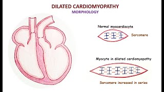 Dilated cardiomyopathy [upl. by Nrehtac203]