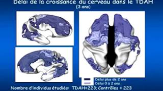 TDAH  Les Neurosciences expliquent le fonctionnement du cerveau [upl. by Hubing548]