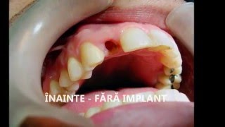 Implant dentar rapid  GM Clinic Timisoara [upl. by Normie]