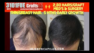 3101FUE Grafts Best in 1HT 5 mths early growth Bad quality hair Thingreasy 28hg 29972024 [upl. by Acimaj]