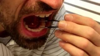 Removing my own salivary gland stone [upl. by Nyrrad695]