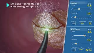 MOSES™ 20 Technology Holmium Laser for Lithotripsy Animation [upl. by Iek178]