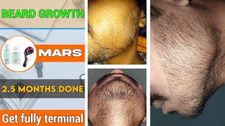 BEARD GROWTH  Get fully terminal  दाढ़ी के बाल जल्दी मोटे होंगे  25 months done  From minoxidil [upl. by Ttegdirb290]