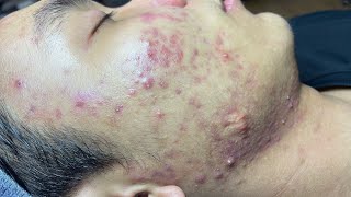 ACNE TREATMENT VU QUYNH MI Blackheads On Boy Face 2024 [upl. by Clemente]