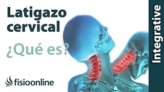 Latigazo cervical  ¿Qué es y cuáles son las claves de su solución [upl. by Shotton387]