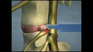 Lumbar Disc Herniations [upl. by Merry319]