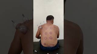 Hijama Sunnah hai chandnihealthexperthijama cuppingtherapy cuppinghadees islam shorts ilaj [upl. by Nolahs]