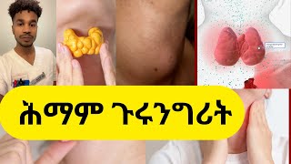 hypothyroidismhypotyreos áˆ•áˆ›áˆ áŒ‰áˆ©áŠ•áŒáˆªá‰µ [upl. by Kristopher]