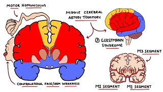 Middle Cerebral Artery Stroke Syndromes  MCA Stroke Syndromes With Gerstmann Syndrome amp Lesions [upl. by Yldarb]