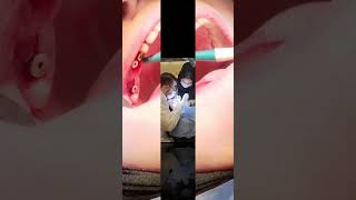 Dentium implantأفضلطبيباسنانبتركيا [upl. by Ebneter]