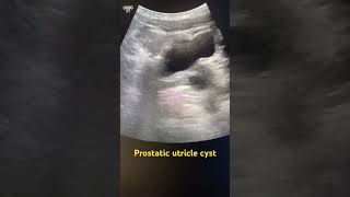 Prostatic utricle cyst prostatetrasound radiology radiography ultrasoundmadeeasy [upl. by Namialus]