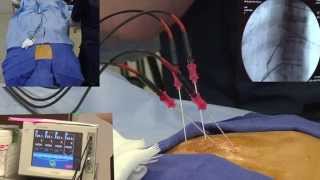 Radiofrequency Ablation Explanation Video Demonstration  LIVE [upl. by Bergman]