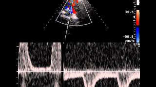 SUBCLAVIAN ARTERY STEAL [upl. by Yrtnej]