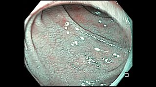 Celiac disease Endoscopic findings [upl. by Ellednek631]