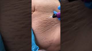 Stretch Marks Inkless Removal Boleyn Treatment Los Angeles 🌍 shorts [upl. by Amarillis]