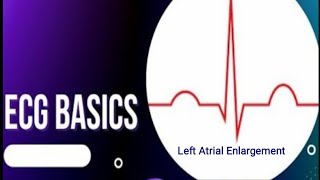 ECG Basics  Left Atrial Enlargement ECG Changes in Left Atrial Enlargement [upl. by Sender758]