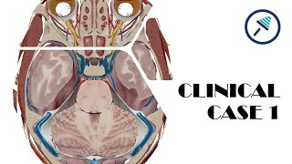 Brain herniations  Case 1 [upl. by Ohce503]