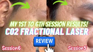 My 1st to 6th Session Results with Co2 Fractional Laser Treatment for my Acne Scars  Before After [upl. by Patricio62]