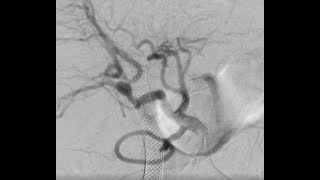 Hepatic pseudoaneurysm embolised with coils and Onyx [upl. by Ocirred594]