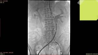 Ankura AAA stent graft system case video [upl. by Mandych254]