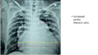 Chest X Ray Lesson 6 Cardiomegaly [upl. by Tamiko]