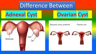 Difference Between Adnexal Cyst and Ovarian Cyst [upl. by Yran]