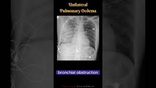 Unilateral Pulmonary Oedema Differential Diagnosis Radiology tutorials shorts [upl. by Nnaeus]