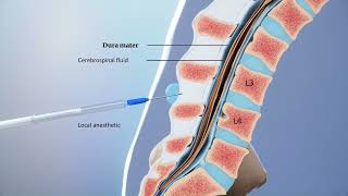 Lumbar Puncture 101  Understanding Study Procedures in ALS Clinical Trials [upl. by Nbi]