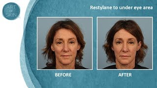 Undereye filler with Restylane Dr Palm San Diego [upl. by Lhok]