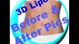 3D Lipomed before and after pics [upl. by Omsare462]