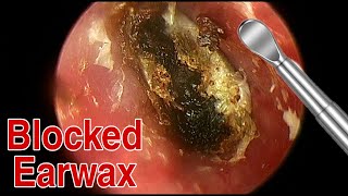 BIGGEST Ear Wax Difficult Removal  EP5  Doctor Anh [upl. by Weld929]