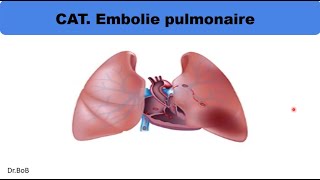 conduite à tenir devant une embolie pulmonaire [upl. by Niko]