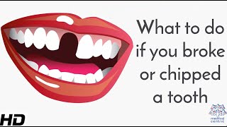 What To Do If You Broke Or Chipped A Tooth [upl. by Oby866]