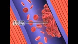 Formation of Deep Vein Thrombosis [upl. by Ellessig]