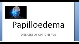 Ophthalmology Papilledema amaurosis fugax sometimes loss of vision cant see Hayreh theory [upl. by Terle271]