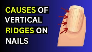 The Cause Of Vertical Ridges on Your Nails [upl. by Hanson]