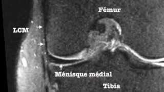 Plan Ligamentaire Médial interne du Genou [upl. by Ymmas]