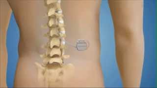 Spinal Cord Stimulation System for Chronic Pain [upl. by Pontius]