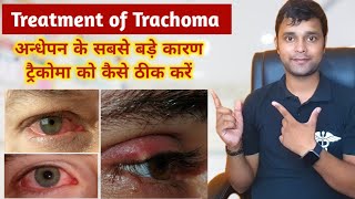 Treatment of Eye Infection  Trachoma Treatment  Eye lids infection  Eye flu ka ilaj kaise kre [upl. by Natrav]