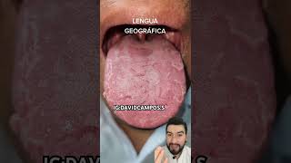 LENGUA GEOGRAFICA [upl. by Barclay768]